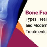 Bone Fractures: Types, Healing Time, and Modern Treatments