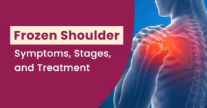 Read more about the article Frozen Shoulder: Symptoms, Stages, and Treatment