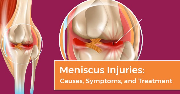 Meniscus Injuries: Causes, Symptoms, and Treatment