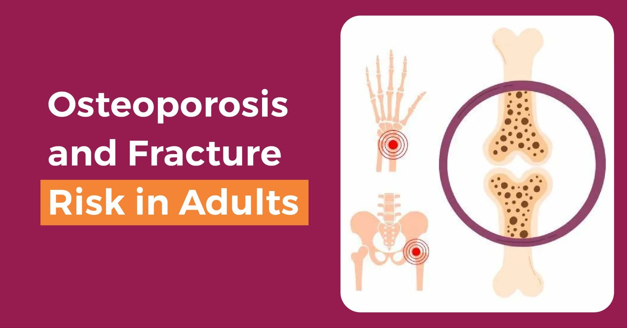 Osteoporosis and Fracture Risk in Adults