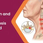 Neck Pain and Cervical Spondylosis Explained